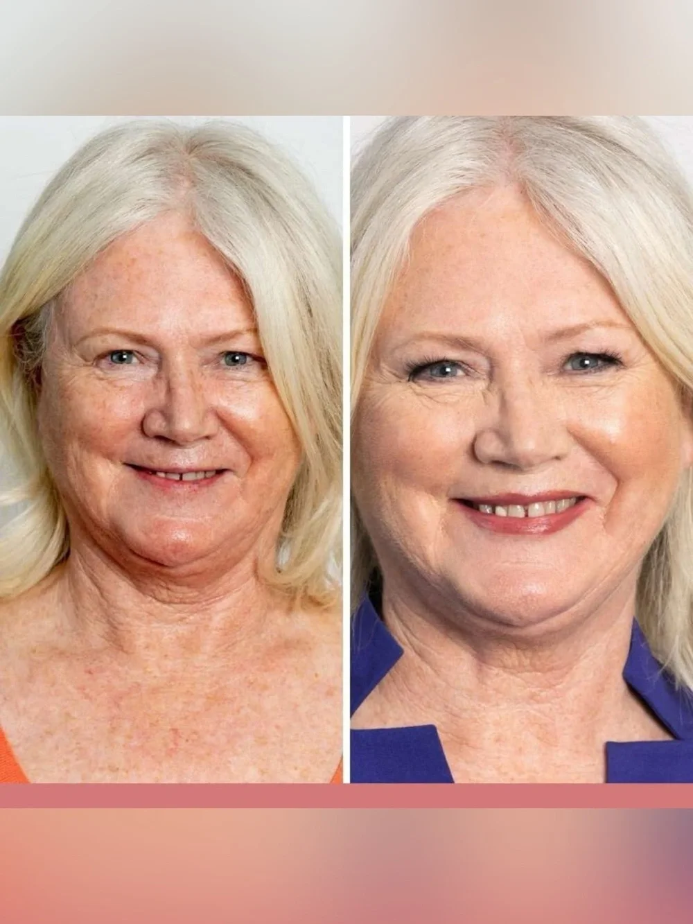 Jerome Alexander undereye tightener